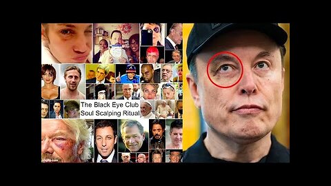 SMHP: Pedophile Elon Musk Black Eye And You Don't Talk About Fight Club!