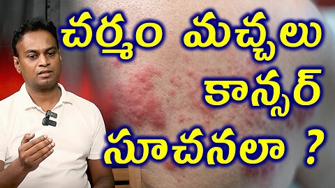 చర్మం మచ్చలు కాన్సర్ సూచనాలా? Skin Rashes are Signs of Cancer Treatment Medicine Homeopathy Cure