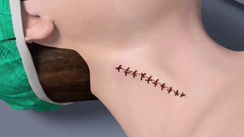 Cervical Disc Replacement Surgery (3D Animation)