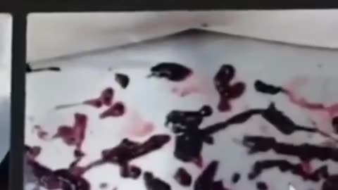 Trombos súbitos y fulminantes en todos los vacunados con el COVID