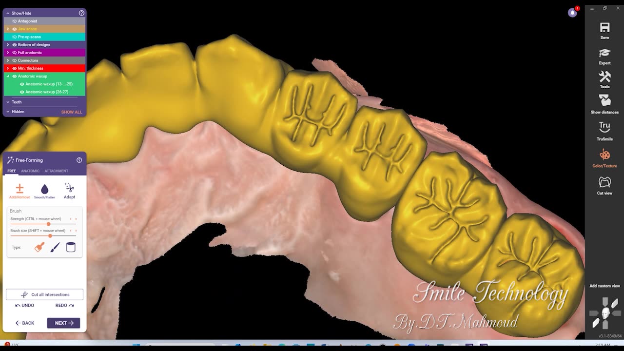 #design #naildesign #dental #dentaldesign #exocadexpert