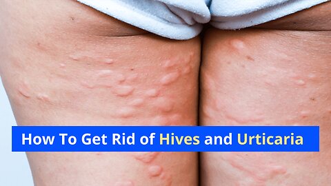 How to get rid of hives and urticaria