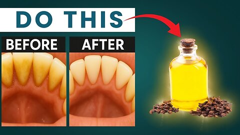 Whiten Teeth & Remove Plaque Naturally in Minutes! | 5 Powerful Home Remedies
