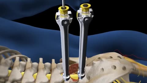 Lumbar Fusion Surgery 3D Animation