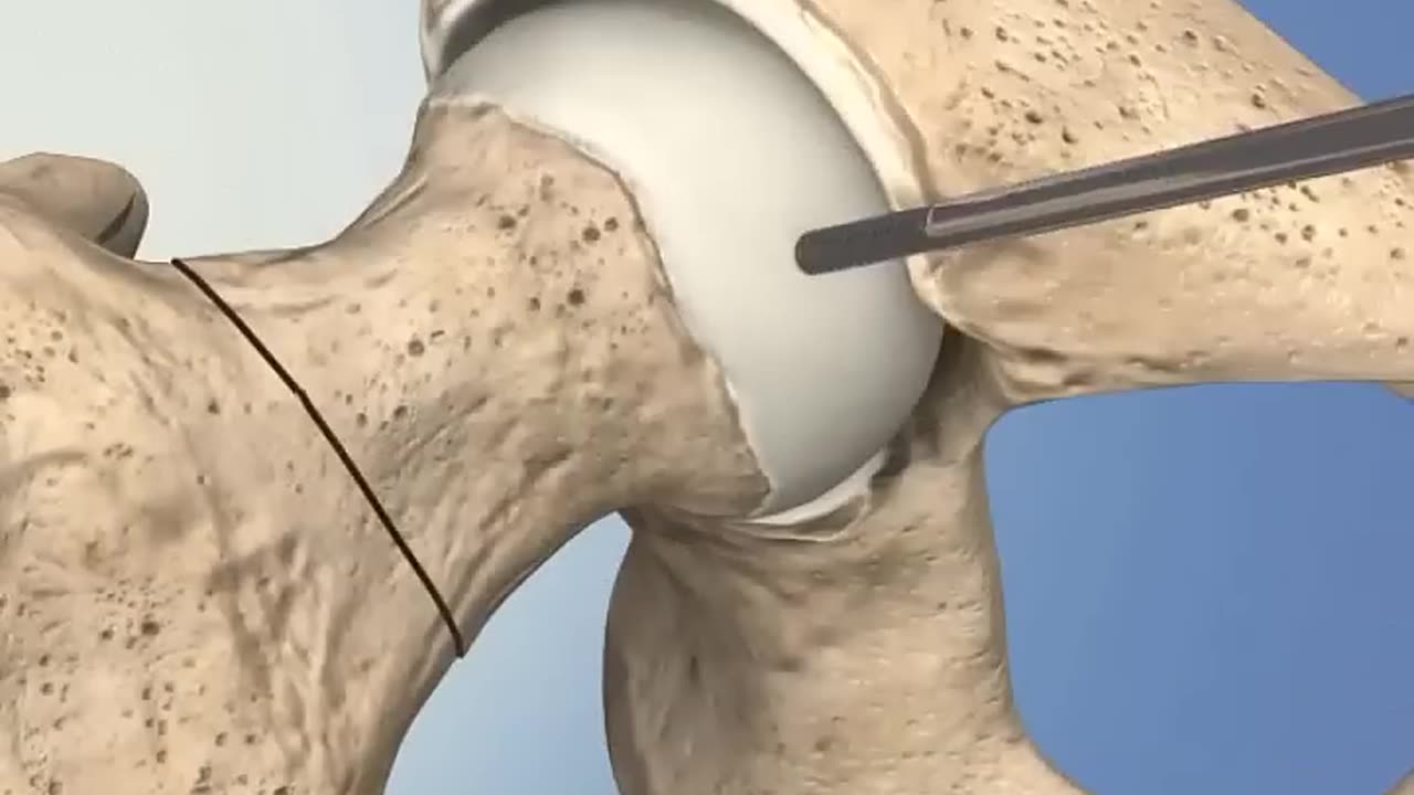 Hip Replacement Anterior Surgery Explained 👨⚕️ Fast Recovery Technique! #Shorts #Education