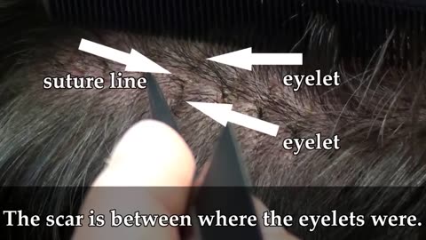 Dr. Brett Bolton Performs Scarless Hair Transplant | 10-Day Transformation