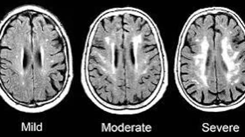 Small-Vessel-disease-of-the-brain