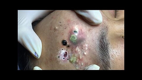 Blackheads Removal & Pimple Popper Cystic Acne Extraction 5