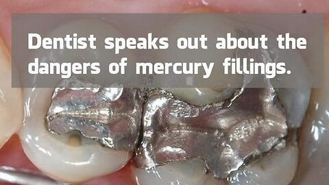"Understanding the Health Risks Associated with Mercury Dental Fillings"