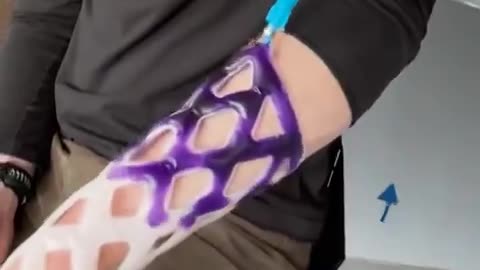 An alternative type of cast