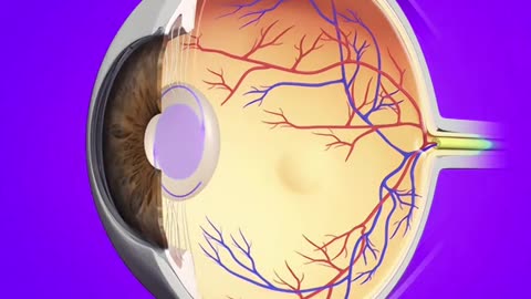 Cataract Eye Surgery (3D Animation)