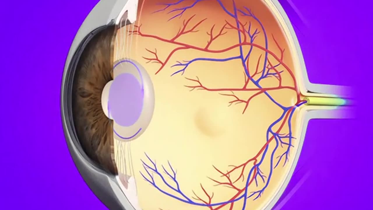 Cataract Eye Surgery (3D Animation)