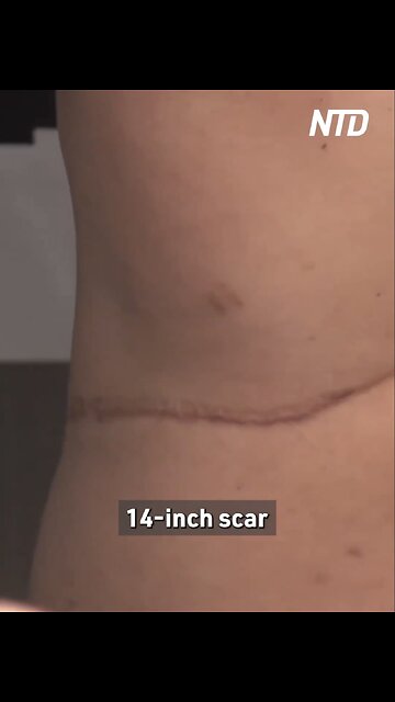 NTD TELEVISION NEWS SPECIAL REPORT🎬🎤👩‍💼ON CHINA-ORGAN HARVESTING🫁🫀💫