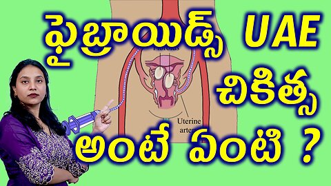 ఫైబ్రాయిడ్స్ కి UAE చికిత్స అంటే ఏంటి ? Uterine Artery Embolization, Fibroids Aretery Blood Blocking