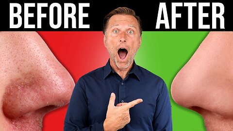 The BEST BLACKHEAD & Acne Remedy in the World (One-Time Fix)
