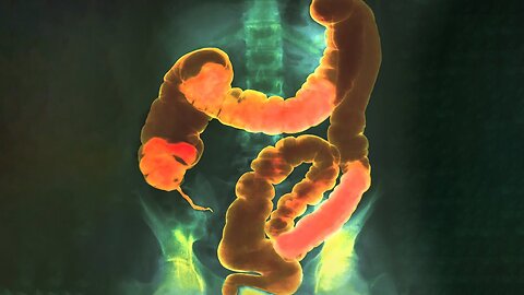 A Student Ate 20 Protein Bars Everyday For 6 Weeks. This Is What Happened To His Intestines.