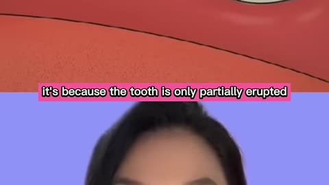 Bad Breath from a Wisdom Tooth #badbreath