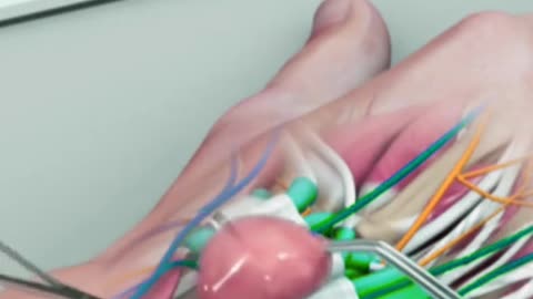 Ganglion Cyst Removal Surgery (3D Animation)
