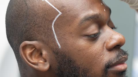 Long Hair Center is renowned for its expertise in afro hair transplants.