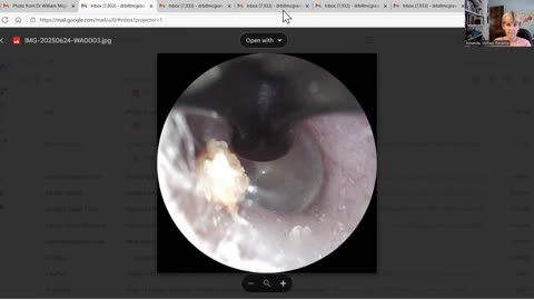 Curing Squamous Cell Carcinoma