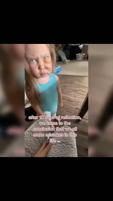 Couple receives backlash for keeping their dog after it mauled & almost killed their toddler