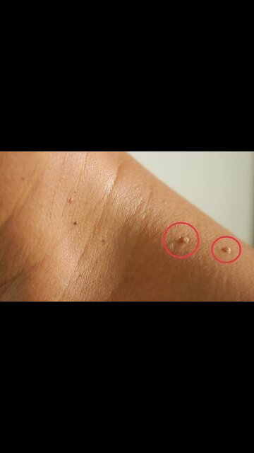 "Skin Tags...Don't Waste Your Money Cutting Them Off.