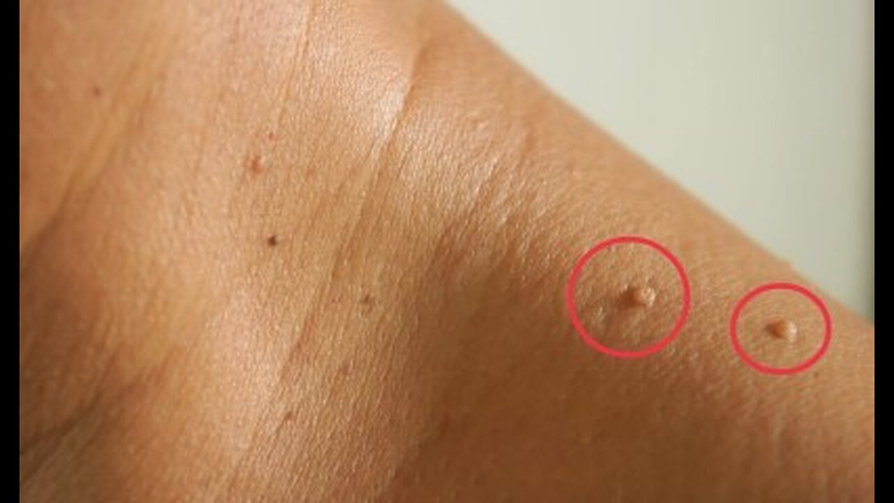 "Skin Tags...Don't Waste Your Money Cutting Them Off.