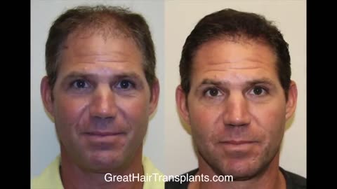 Dr. Brett Bolton’s Incredible 10-Day Suture Removal Result