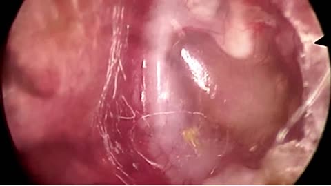 Large Ear Wax Removal From Both Ears