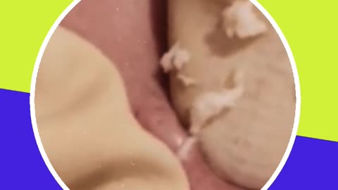 Pimple removal satisfying video (ASMR) #10 #shorts