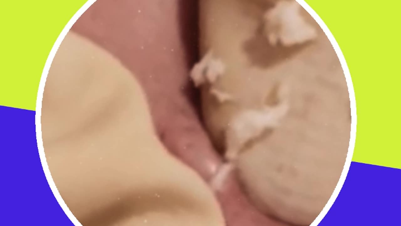 Pimple removal satisfying video (ASMR) #10 #shorts