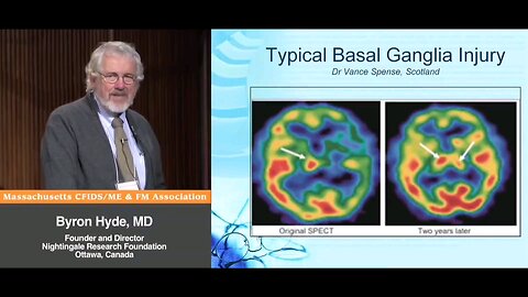 Typical "Basal Ganglia Injury" in "Myalgic Encephalomyelitis" (aka Enteroviral Encephalomyelitis), Parkinson's Disease in Children, and in a proportion of males years later, after previously falling ill with M.E. - Byron Hyde, MD