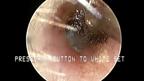 Massive Amount of Ear Wax Removal