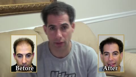 Corrective Hair Transplant Transformation by Dr. Brett Bolton
