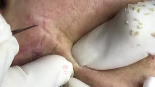 Blackheads Removal & Pimple Popper Cystic Acne Extraction #219