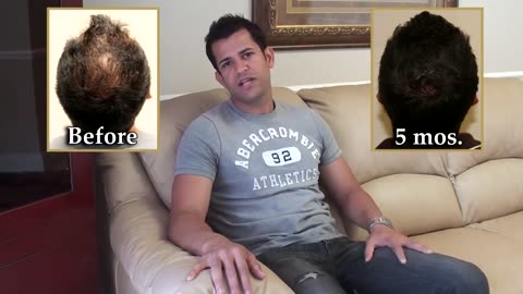 Short Video: Dr. Brett Bolton’s MaxHarvest™ Hair Transplant Results