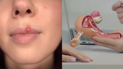 Discovery That Completely Changed The Way We Understand and Treat Herpes