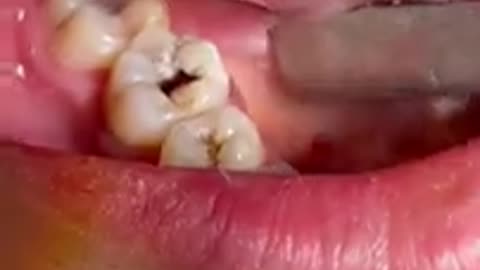 Shocking: #tiktok #video #dentist #fyp #viral #family #trending #foryou #love #s