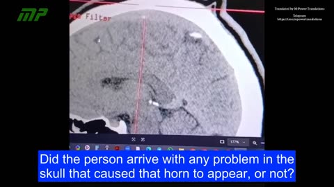 Neurological damage caused by the COVID-19 vaccine.