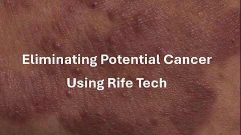 Eliminating Potential Cancer Using Rife Technology