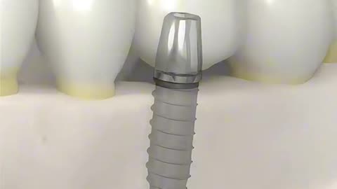 Dental Bone Graft Surgery (3D Animation)