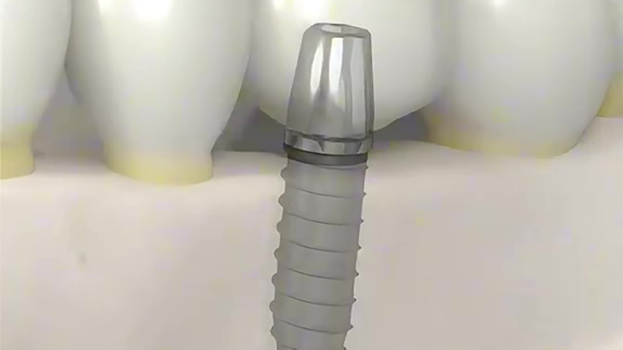 Dental Bone Graft Surgery (3D Animation)