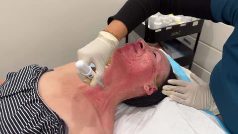 My Skin Needling Experience at Laser Clinics Australia | Pacific Fair, Gold Coast #SkinNeedling