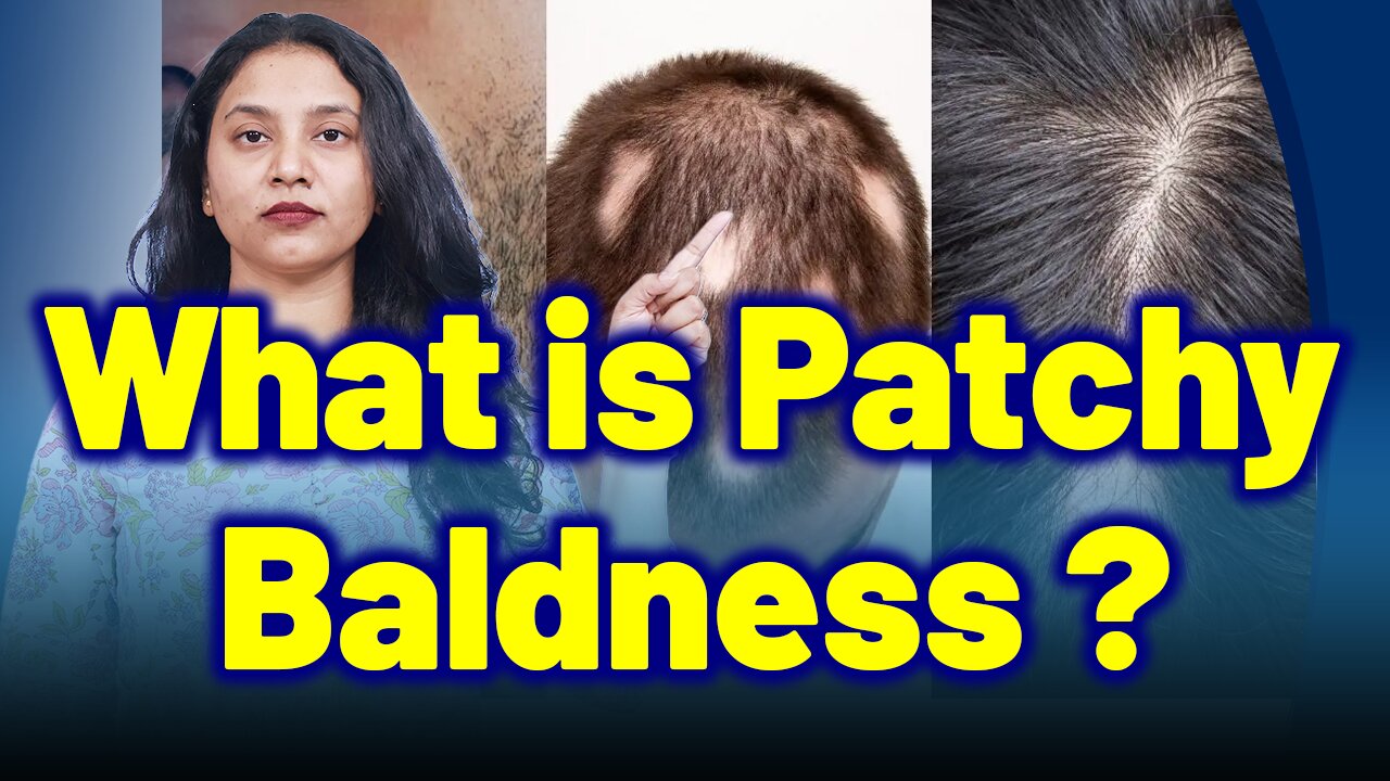 What is Alopecia Areata, Patchy Baldness ? | Treatment and Cure | Homeopathy, Medicine & Surgery