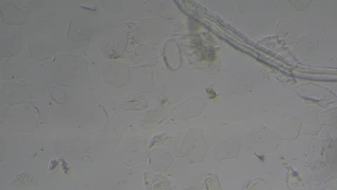 Otomycosis