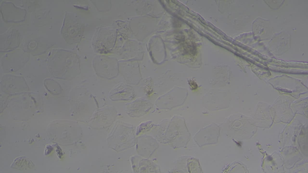 Otomycosis