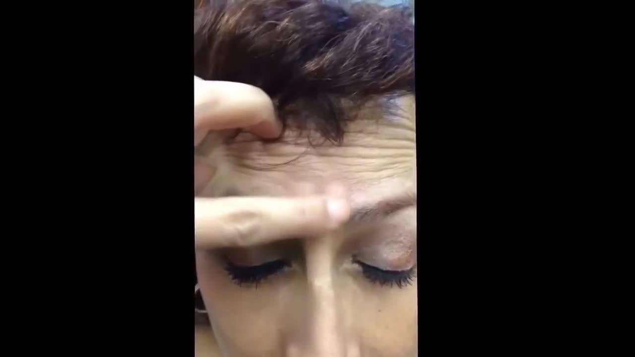 Silicone granulomas from cosmetic filer injection For medical education NSFE