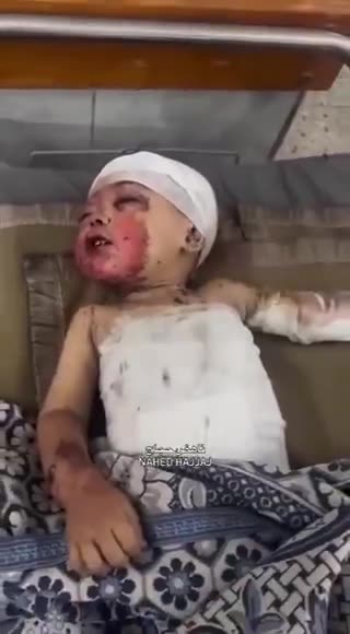A 3-year-old Palestinian boy suffers SEVERE BURNS after IDF strikes Gaza City