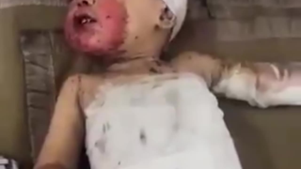 A 3-year-old Palestinian boy suffers SEVERE BURNS after IDF strikes Gaza City