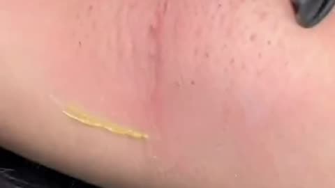 Underarm Waxing with Sexy Smooth Lemon Kiss Hard Wax by @bombfacebeautybar